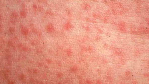 Spalničky: Jaké jsou příznaky, přenos a prevence?