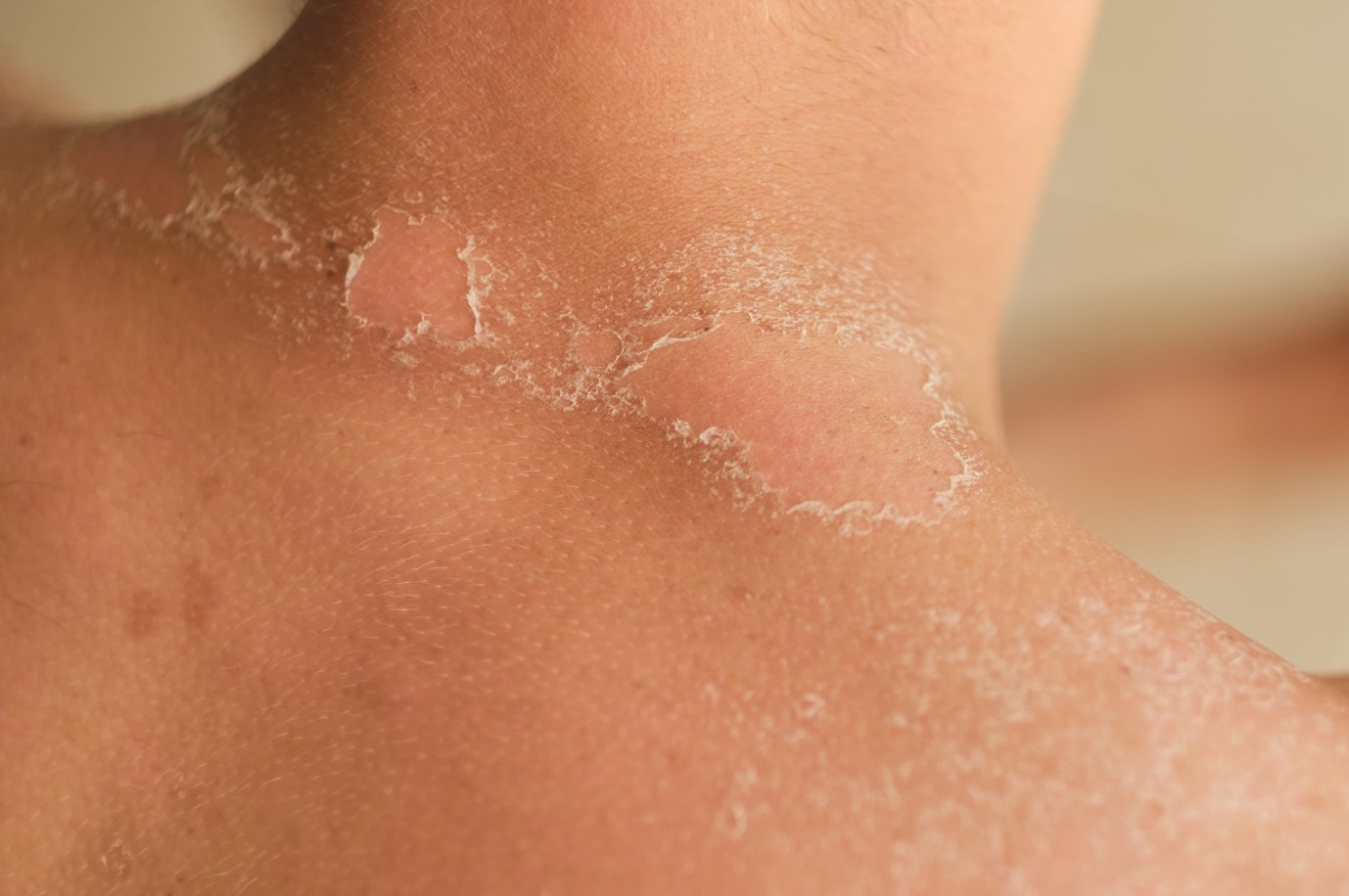 Popáleniny: Stupně, léčba a první pomoc