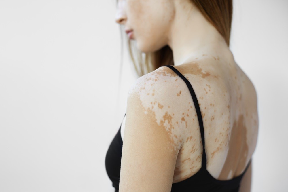 Vitiligo: Příčiny, projevy a léčba