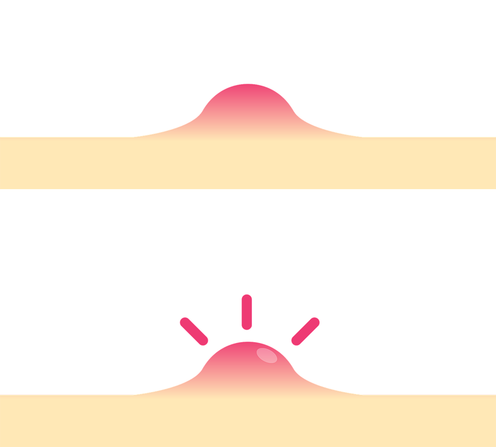 Furunkl a karbunkl – příčiny, projevy a léčba