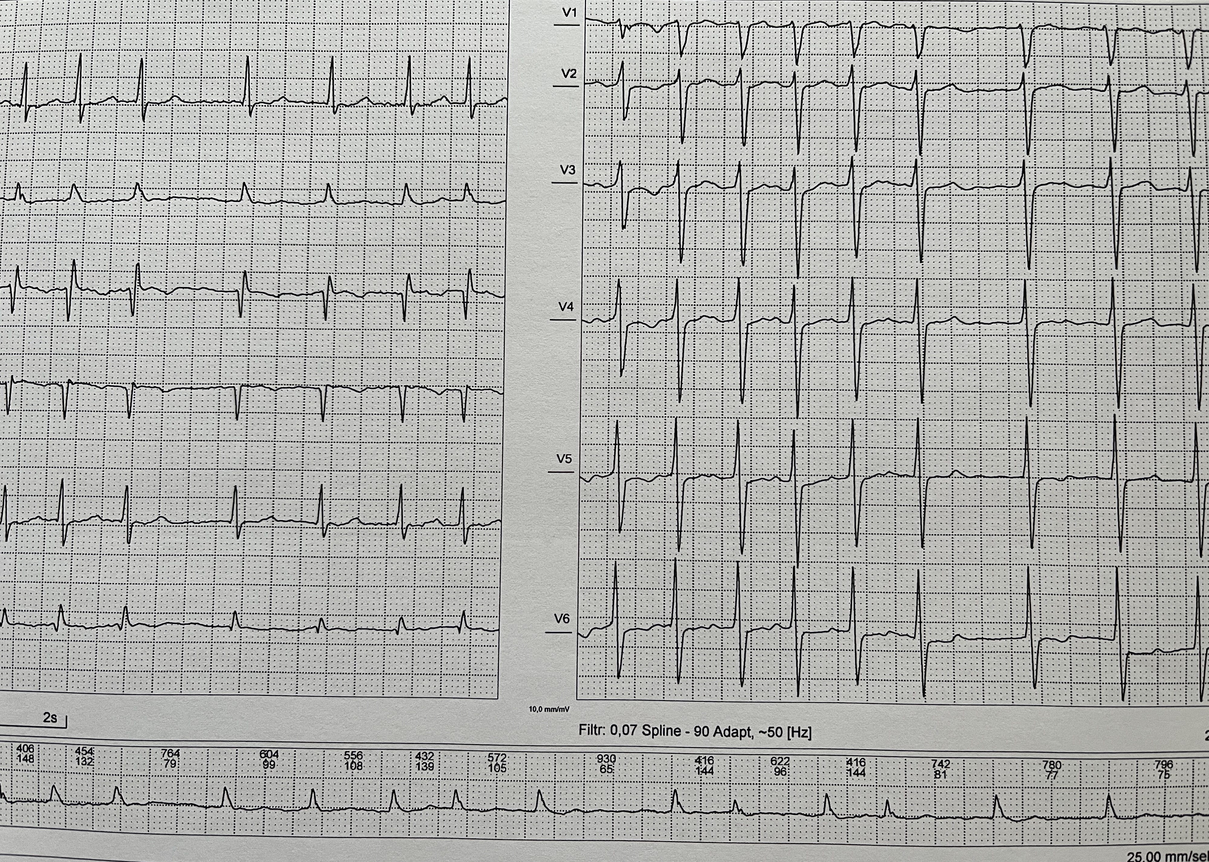 Fibrilace síní: arytmie, se kterou bychom měli všichni jednou počítat