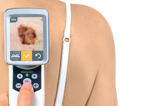 Přijďte na Dny melanomu a nechte si zkontrolovat znaménka